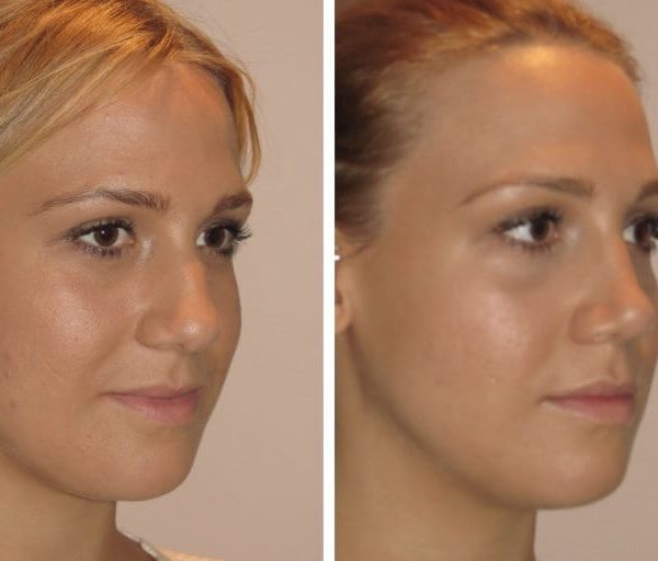Comprehensive Guide to Sydney Rhinoplasty Procedures
