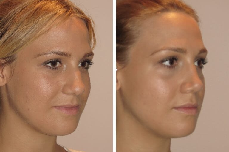Comprehensive Guide to Sydney Rhinoplasty Procedures